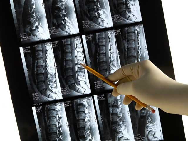 Osteoporoza, face tot mai multe victime! Osteoporoza, face tot mai multe victime!
