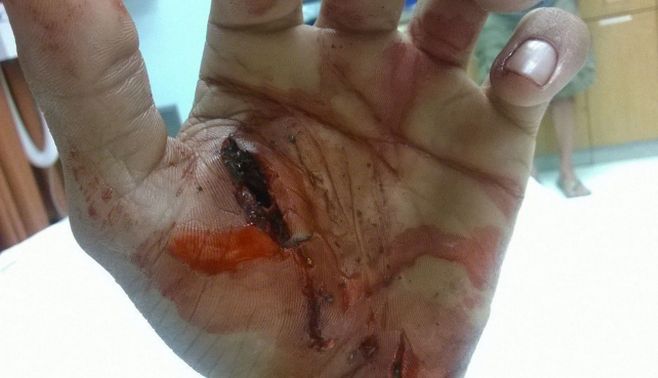 La un pas de a rămâne fără mână! La un pas de a rămâne fără mână!