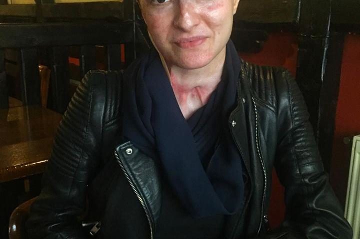 Viaţa după „Colectiv“. Supravieţuitoare: „Nu mai aveam piele pe mâini. A fost un coşmar. Vina ne aparţine tuturor, n-ar trebui să mai închidem ochii la nereguli“ Viaţa după „Colectiv“. Supravieţuitoare: „Nu mai aveam piele pe mâini. A fost un coşmar. Vina ne aparţine tuturor, n-ar trebui să mai închidem ochii la nereguli“