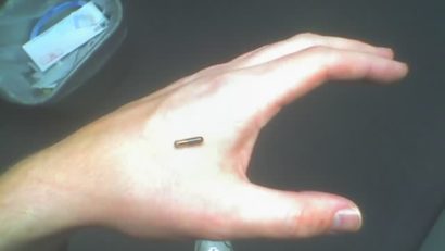 Revoluția invizibilă din sănătate: microcipurile implantabile