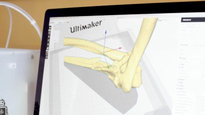 Bone-02: Lipiciul care repară oase fără bisturiu!